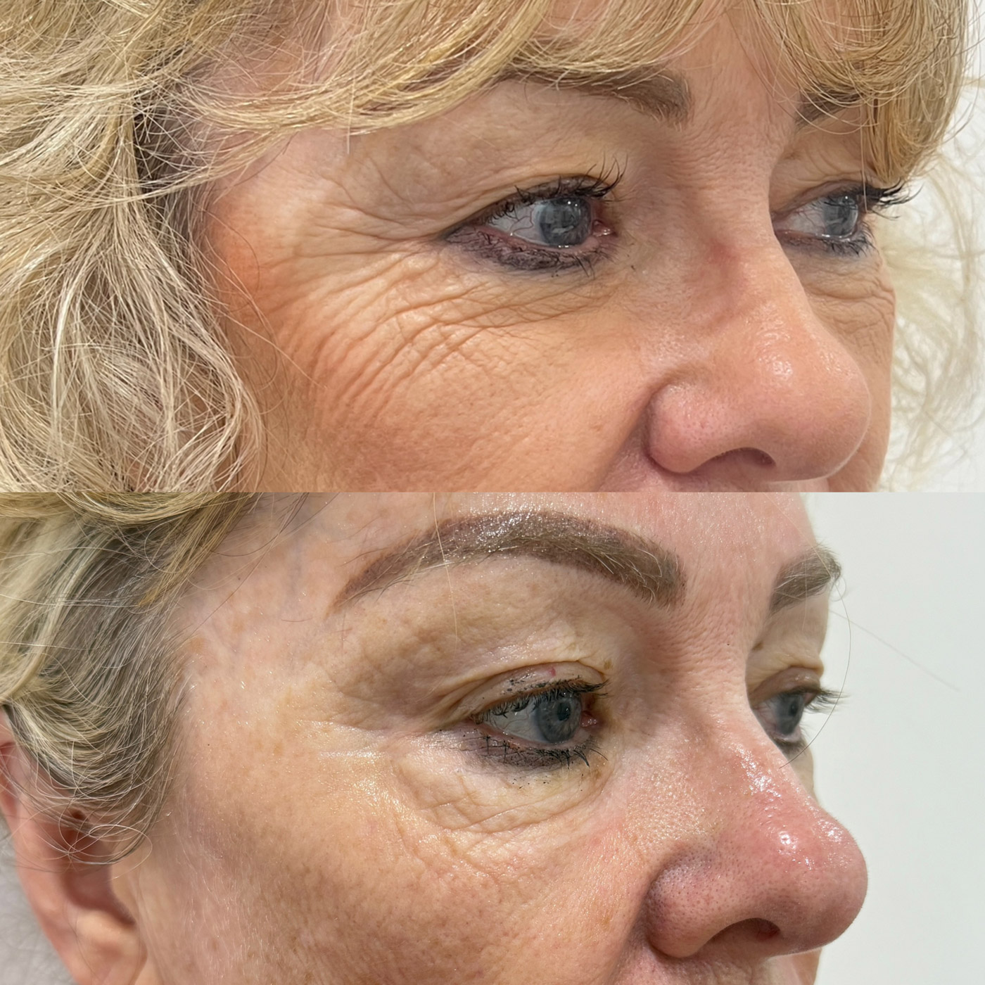 Before and after HIFU around the eye area, from Gabrielle's previous studio