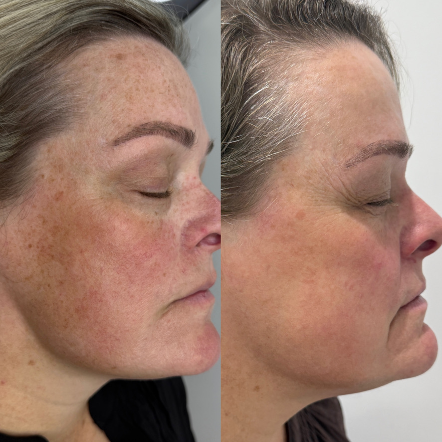 Before and after IPL on the cheek, from Gabrielle's previous studio