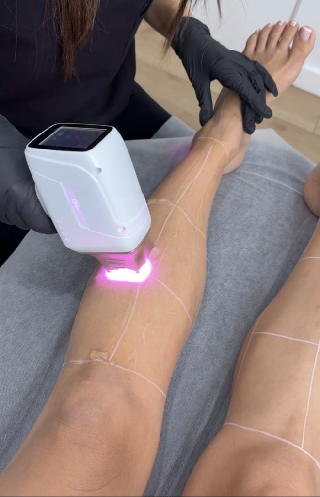 A laser treatment in progress